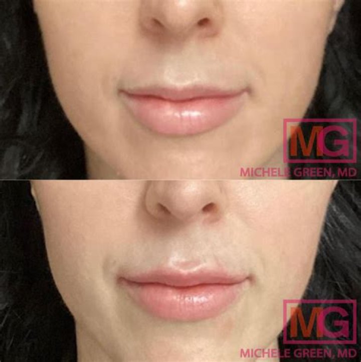 
Emily Ratajkowski Plastic Surgery – Fans Suspect Botox And Lip Filler! 